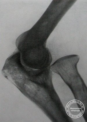 Рентгеновский снимок врожденного двустороннего вывиха головки левой лучевой кости в боковой проекции
