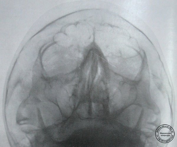 Рентгеновский снимок изолированного перелома верхней челюсти в прямой проекции