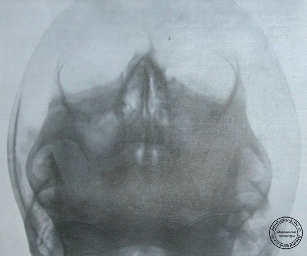 Рентгеновский снимок двустороннего супраальвеолярного перелома верхней челюсти в прямой проекции