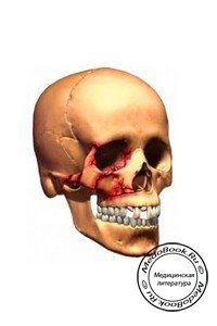 Рентгенодиагностика перелома верхней челюсти с примерами на рентгеновских снимках