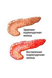 Хронический панкреатит - хроническое воспаление поджелудочной железы