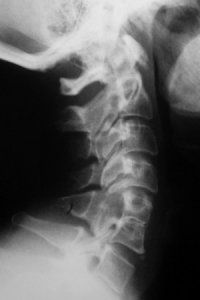 Перелом дуги 2 и 3 шейных позвонков: Рентгенодиагностика