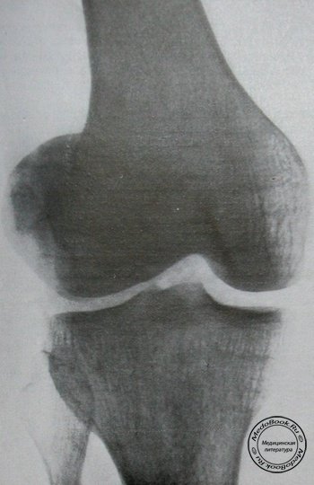 Рентгеновский снимок вывиха надколенника в прямой проекции