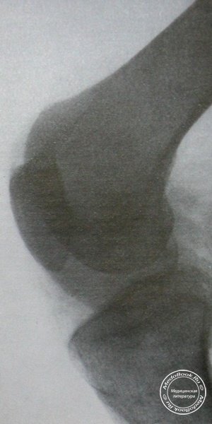 Рентгеновский снимок вывиха надколенника в боковой проекции