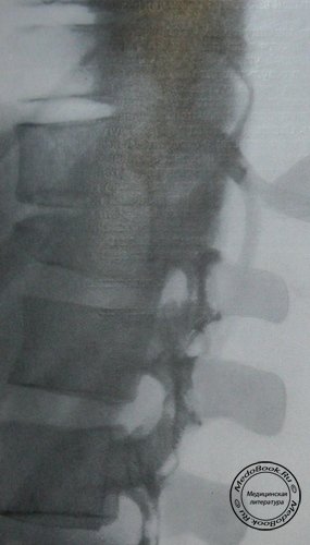 Рентгеновский снимок переломо-вывиха 11 и 12 грудных позвонков в боковой проекции