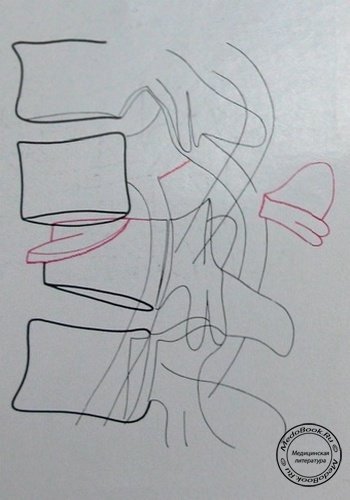 Схема к рентгеновскому снимку переломо-вывиха 11 и 12 грудных позвонков в боковой проекции