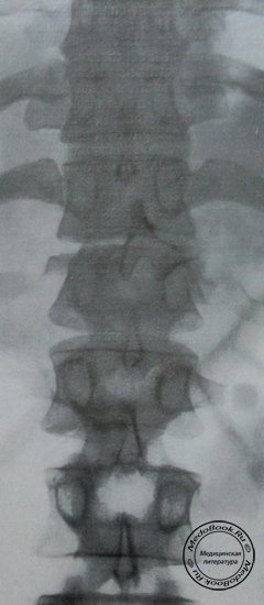 Рентгеновский снимок переломо-вывиха 11 и 12 грудных позвонков в задней проекции