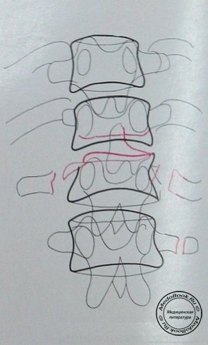 Схема к рентгеновскому снимку переломо-вывиха 11 и 12 грудных позвонков в задней проекции