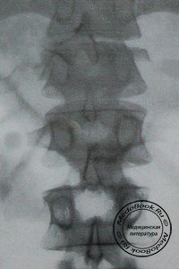 Рентгенодиагностика переломо-вывиха 11 и 12 грудных позвонков