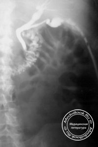 Рентгенодиагностика холедохо-дуоденальных свищей при язвенной болезни