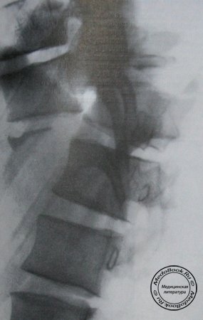 Боковой рентгеновский снимок переломо-вывиха 11 и 12 грудных позвонков