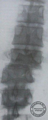 Задний рентгеновский снимок переломо-вывиха 11 и 12 грудных позвонков