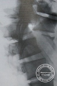 Рентгенодиагностика переломо-вывиха 11 и 12 грудных позвонков с примерами