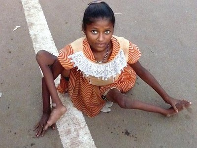 Девочка больная полиомиелитом