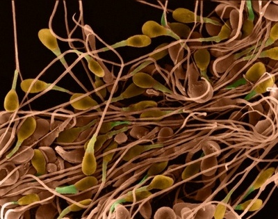 Некроспермия - наличие в семени неподвижных сперматозоидов