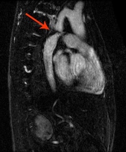 Магнитно-резонансная томография коарктации аорты