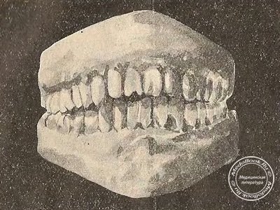 Полулунные выемки образовавшиеся на антагонирующих зубах
