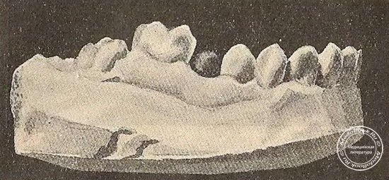 Supra-anomalia: высокое положение альвеолы зуба по сравнению с другими зубами