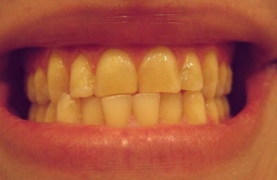 Желтое окрашивание зубов при желтухе