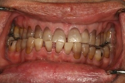 Коричневое окрашивание зубов при отравлении свинцом