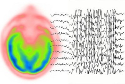 Электроэнцефалограмма больного эпилепсией