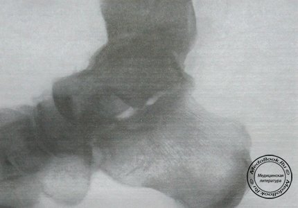Боковой рентгеновский снимок вывиха в Шопаровом суставе