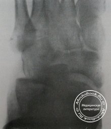 Тыльно-подошвенный рентгеновский снимок вывиха в Шопаровом суставе
