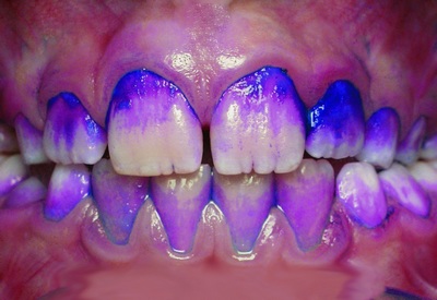 Синие окрашивание зубов