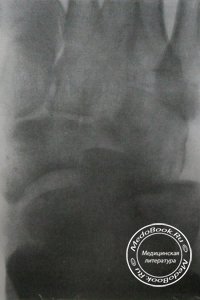 Рентгенодиагностика вывиха в Шопаровом суставе