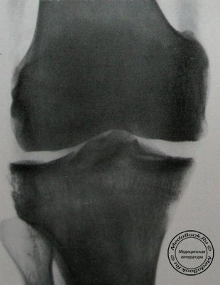 Задний рентгеновский снимок перелома межмыщелкового возвышения большеберцовой кости