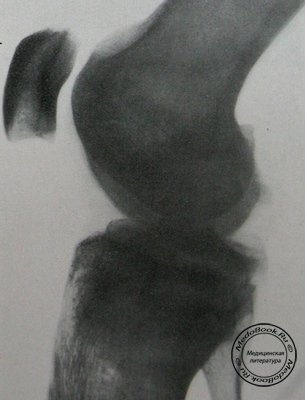 Боковой рентгеновский снимок перелома межмыщелкового возвышения большеберцовой кости
