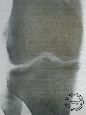 Рентгеновский снимок перелома межмыщелкового возвышения большеберцовой кости в задней проекции