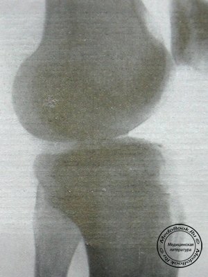 Рентгеновский снимок перелома межмыщелкового возвышения большеберцовой кости в боковой проекции