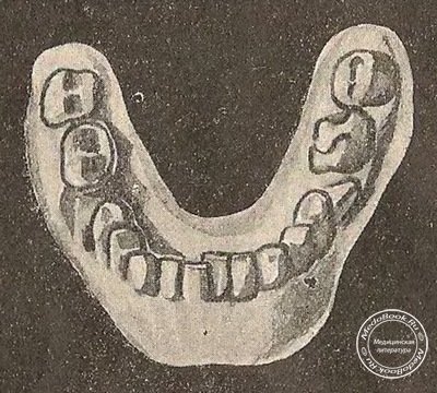 Изображение рахитической нижней челюсти