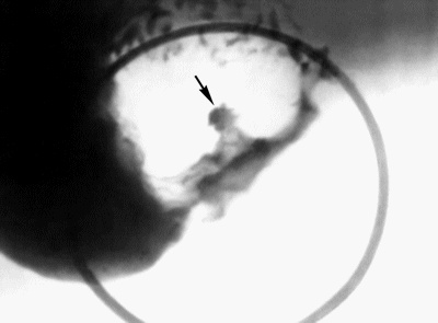 Прицельный рентгеновский снимок язвы двенадцатиперстной кишки