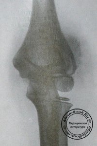 Отслоение эпифиза головки плечевой кости: Рентгенодиагностика