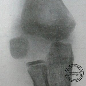 Рентгеновский снимок перелома латерального мыщелка в задней проекции
