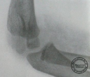 Рентгеновский снимок перелома латерального мыщелка в боковой проекции