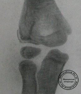 Рентгеновский снимок перелома латерального мыщелка в задней проекции у 8-летнего мальчика