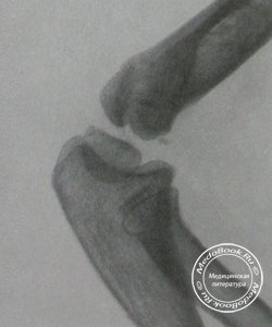 Рентгеновский снимок перелома латерального мыщелка в боковой проекции у 8-летнего мальчика