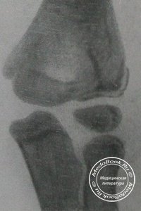 Перелом латерального мыщелка: Рентгенодиагностика