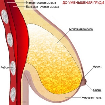 Отвисание гипертрофированной грудной железы до редукционной маммопластики