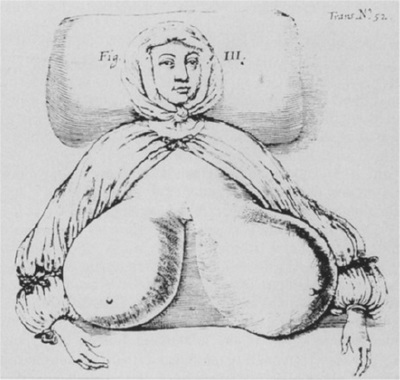 Hypertrophia mammae diffusa у 24-летней женщины (изображение 1670 года)