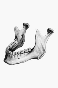 V-образная нижняя челюсть и пороки развития ее альвеолярного отростка