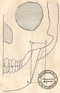 Механизм образования рахитической верхней челюсти