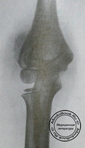 Задний снимок правого локтевого сустава с отслоением эпифиза головки плечевой кости