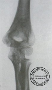 Задний снимок левого локтевого сустава без отслоения эпифиза головки плечевой кости