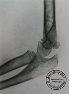 Боковой снимок правого локтевого сустава с отслоением эпифиза головки плечевой кости