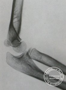 Боковой снимок левого локтевого сустава без отслоения эпифиза головки плечевой кости