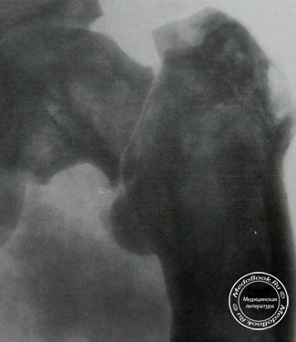 Рентгеновский снимок перелома шейки бедренной кости при болезни Педжета